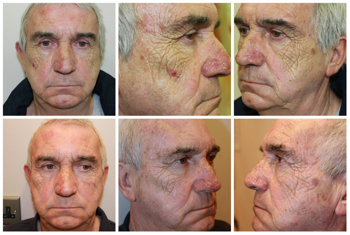 Facial rejuvenation